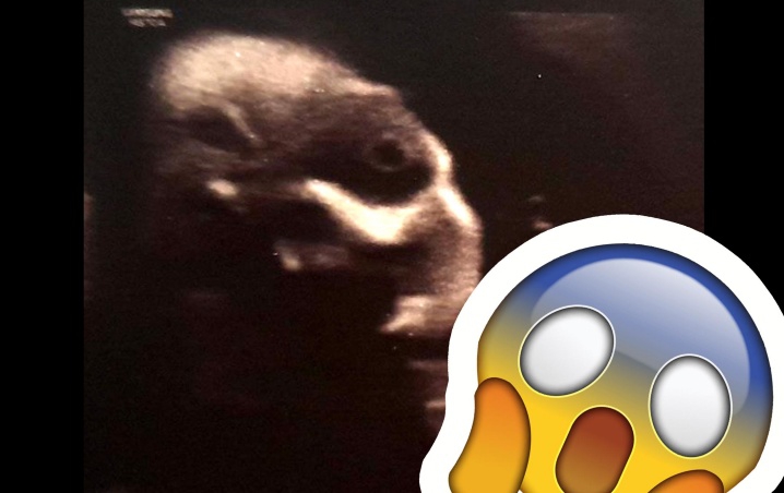 Ultrasonido reveló una forma aterradora en el vientre de una mujer