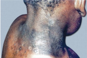 Photosensitive, well-demarcated erythematous rash around the neck and upper chest (Casal necklace) in pellagra