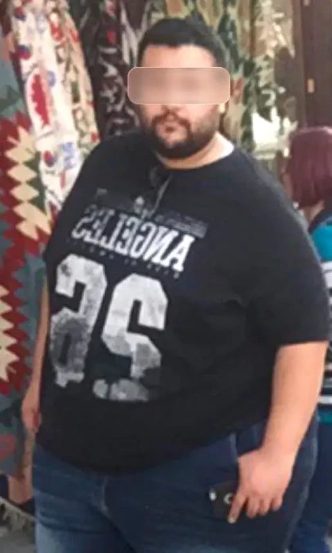 Patient before weight loss journey