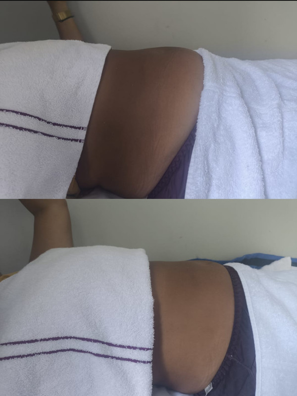 Antes e depois do tratamento com ventosas