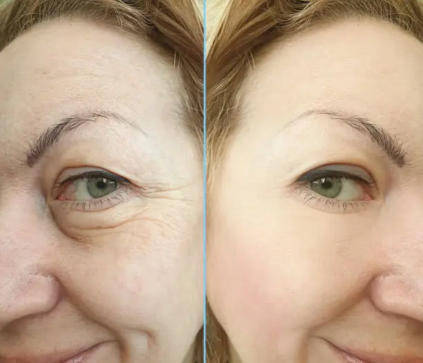 Before and After Face