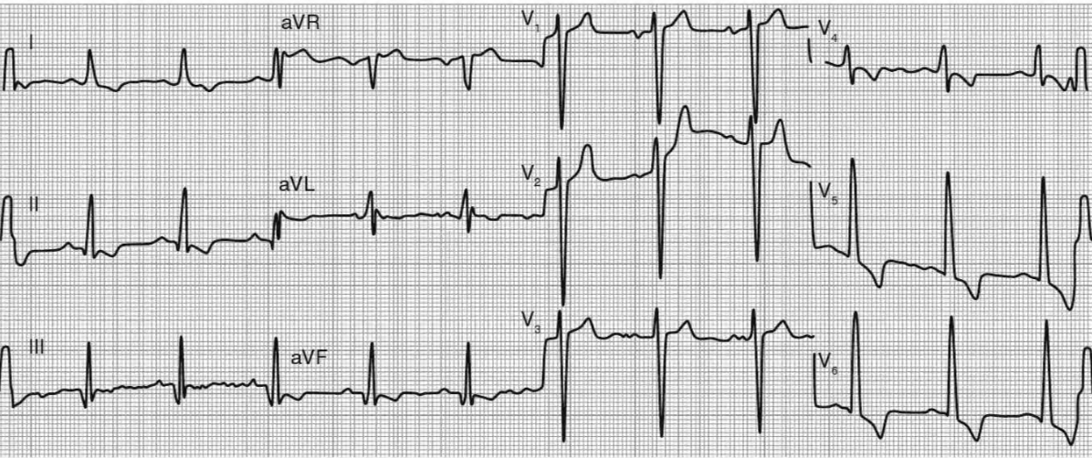 ЭКГ больного с хронической АР.