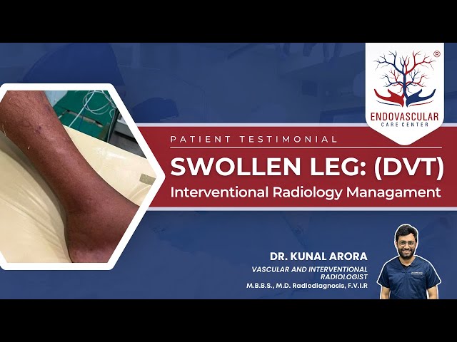 Swollen Leg (DVT) Treatment through Interventional Radiology | Dr. Kunal Arora