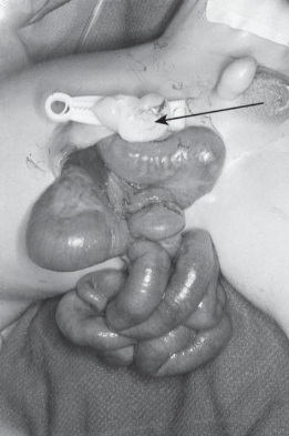 Gastroschisis - right-sided abdominal wall defect, eviscerated small bowel, no covering membrane