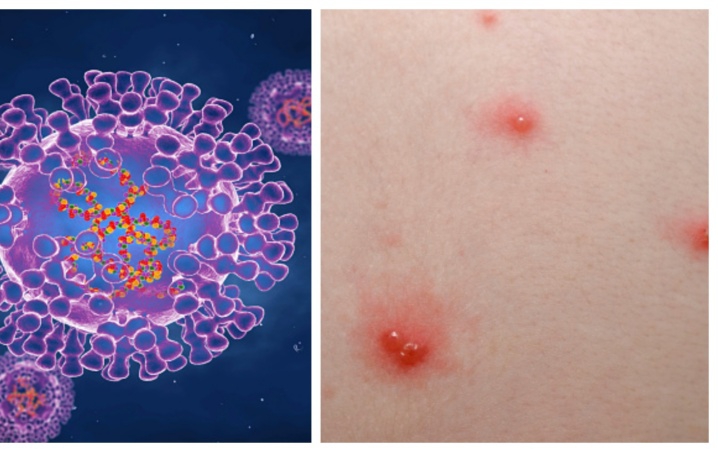 India confirma su primer caso de viruela del mono