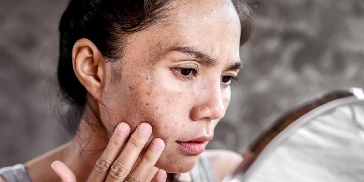 Hyperpigmentation & Role of Q Switch Laser