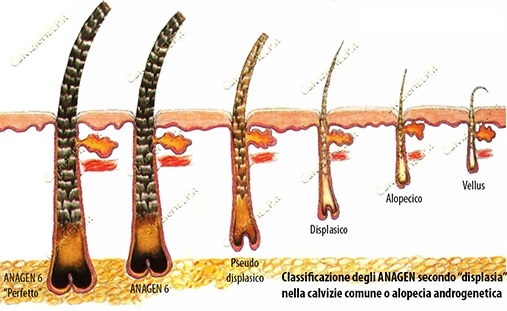 gradi-displasia-alopecia-2