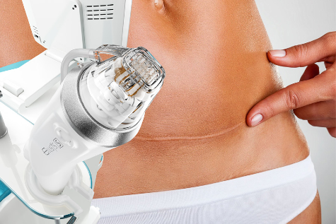 Девушка перед удаление шрамов