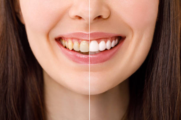 Teeth Whitening Park Ridge