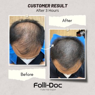 Before and after treatment for male pattern baldness in Penang