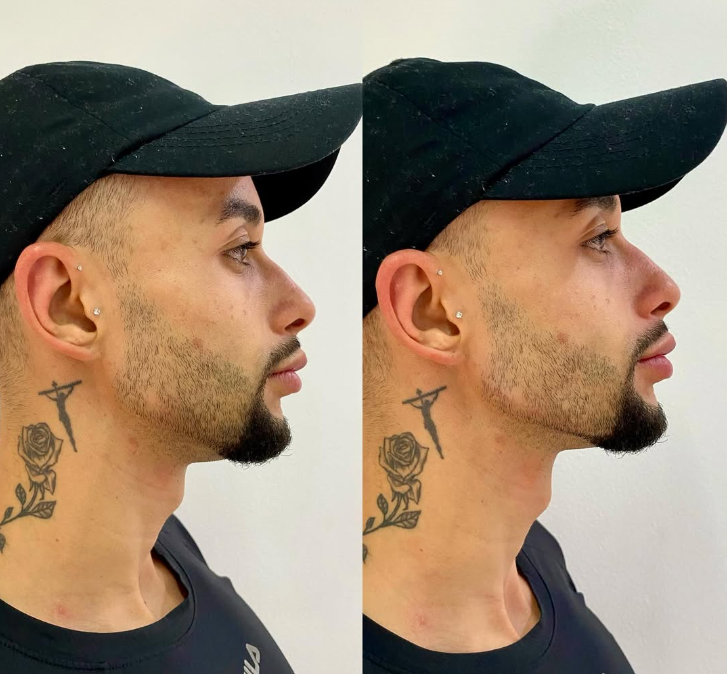 Resultado preenchimento facial