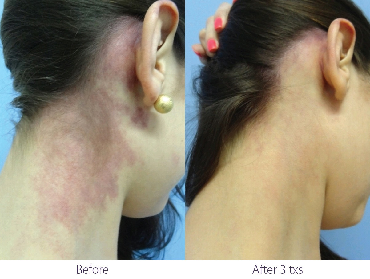 Before and after IPL treatment for vascular lesions at Let's Face It Med Spa in Denver.