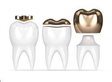 Coroas sobre Implante