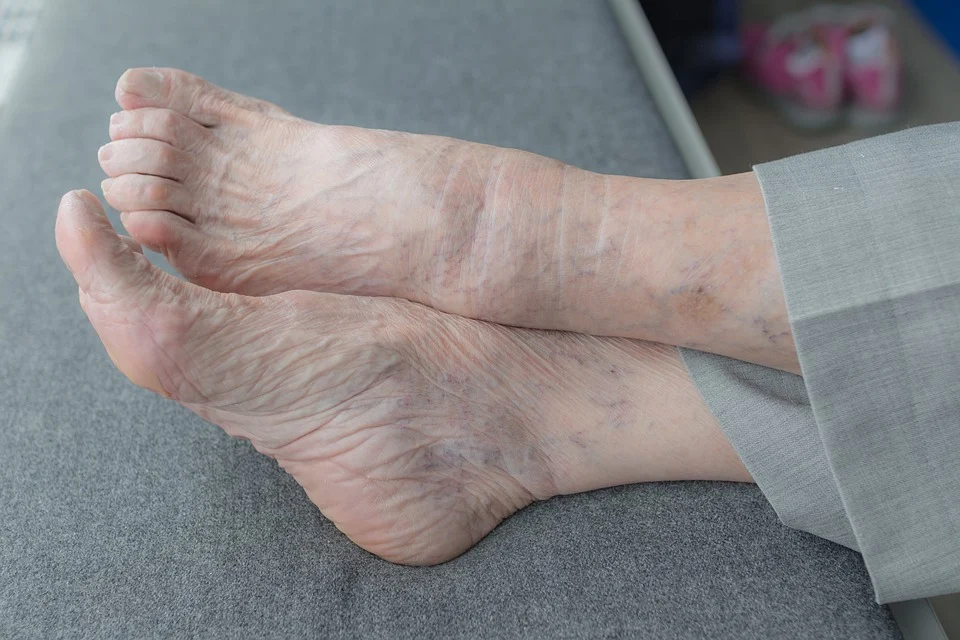 Foot Fat Pad Atrophy Treatment Near Kansas City