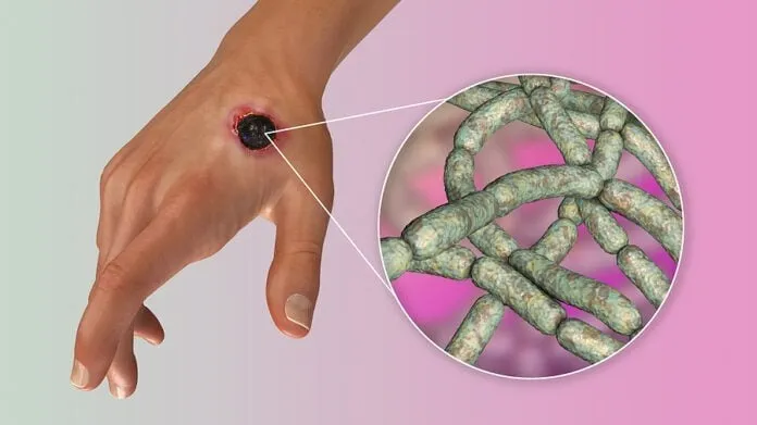 Excesivo brote de ántrax pone en alerta a los autoridades sanitarias de todo el mundo