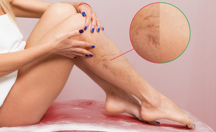 tratamientos para varices