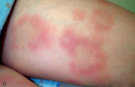 Expanding erythematous rash with central clearing (bull's-eye) on the thigh - erythema migrans in Lyme disease