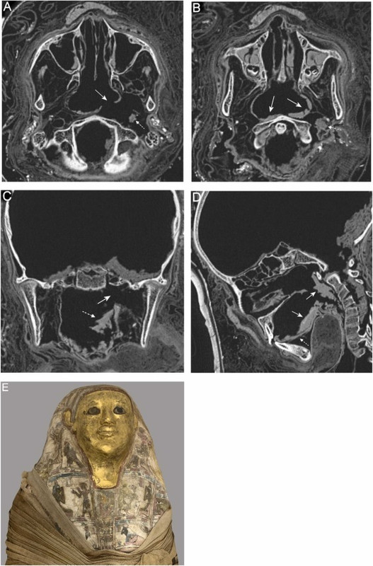 Misteriosa momia egipcia herida abre nuevas incógnitas sobre la medicina antigua