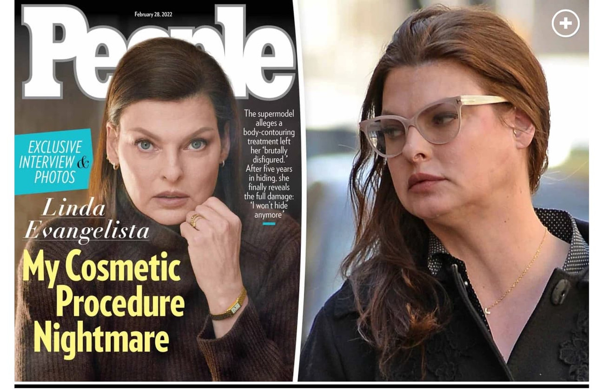 In un'intervista a People, la top model, 56 anni, ha parlato del dolore sia fisico che emotivo a cui è andata incontro in questi anni dopo un'intervento di rimozione del tessuto adiposo (criolipolisi ) che l'ha lasciata sfigurata.