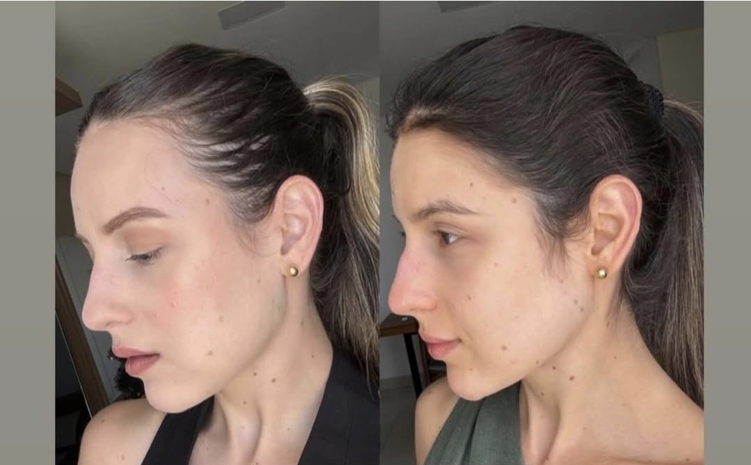 Antes e depois da terapia regenerativa 2