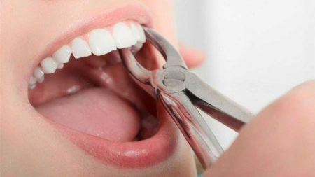 Dental Extraction   Basic Principles, Forceps & Elevators