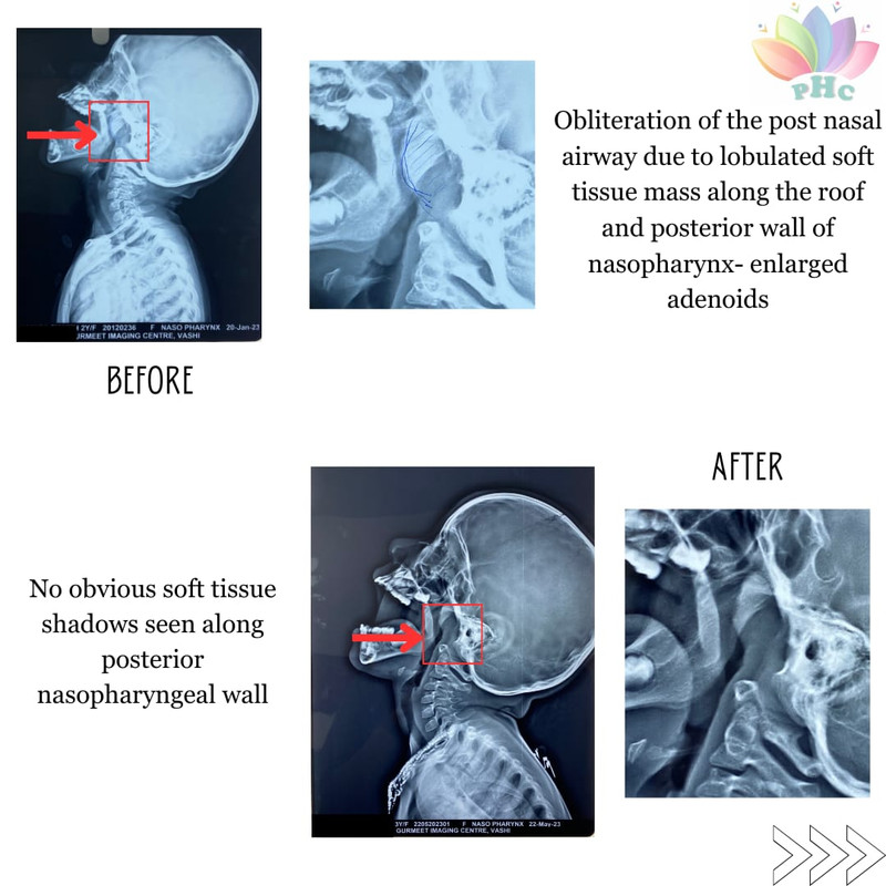 Enlarged adenoids treatment before and after