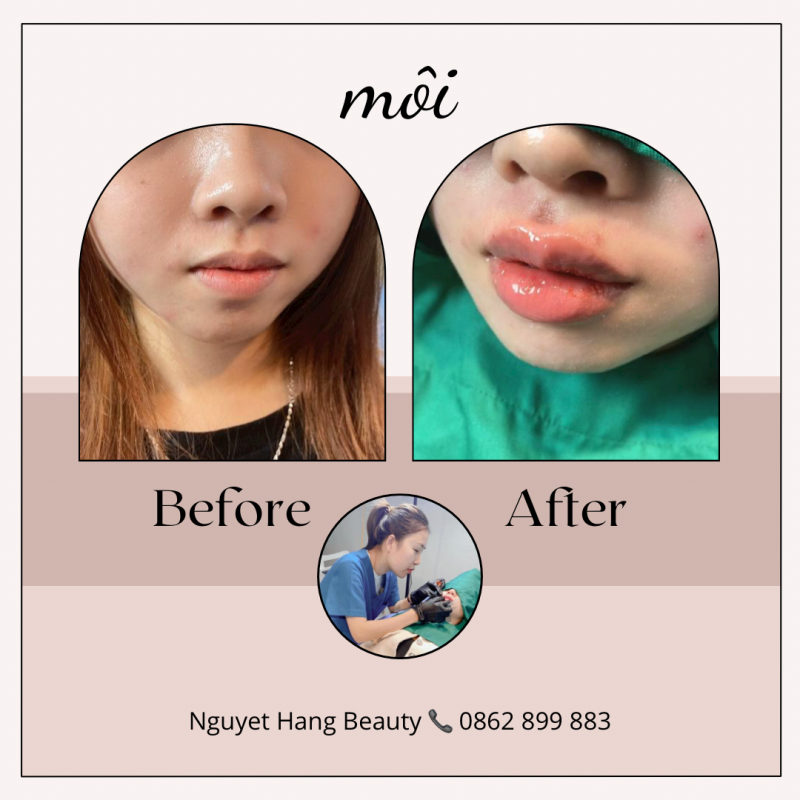 tiêm filler môi ở Bắc Giang, tiêm môi