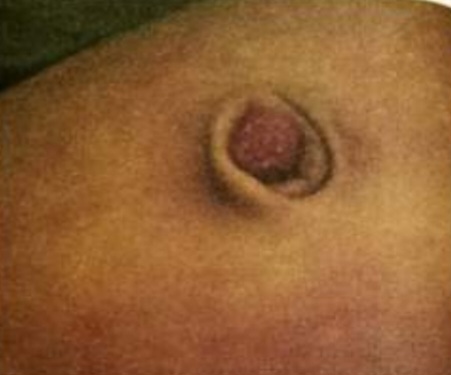 Umbilical granuloma - clinical photograph