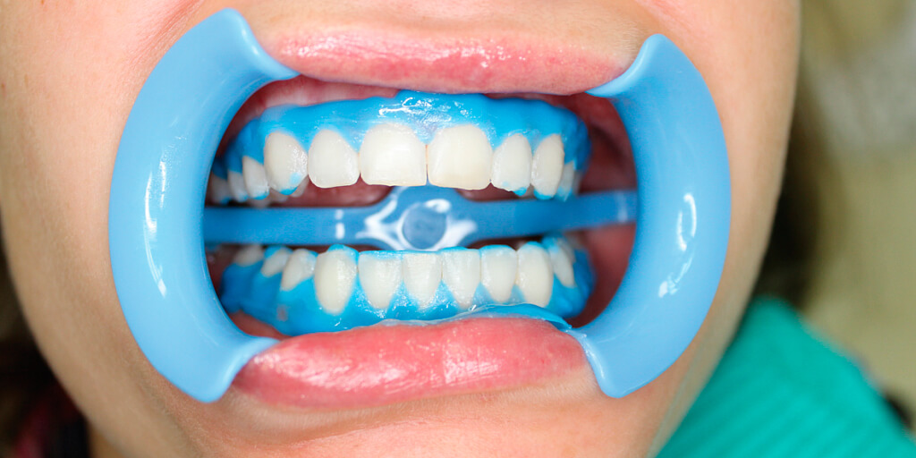 Отбеливание зубов: сделает вашу улыбку красивой