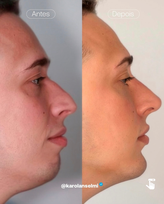 Antes e Depois - Facial