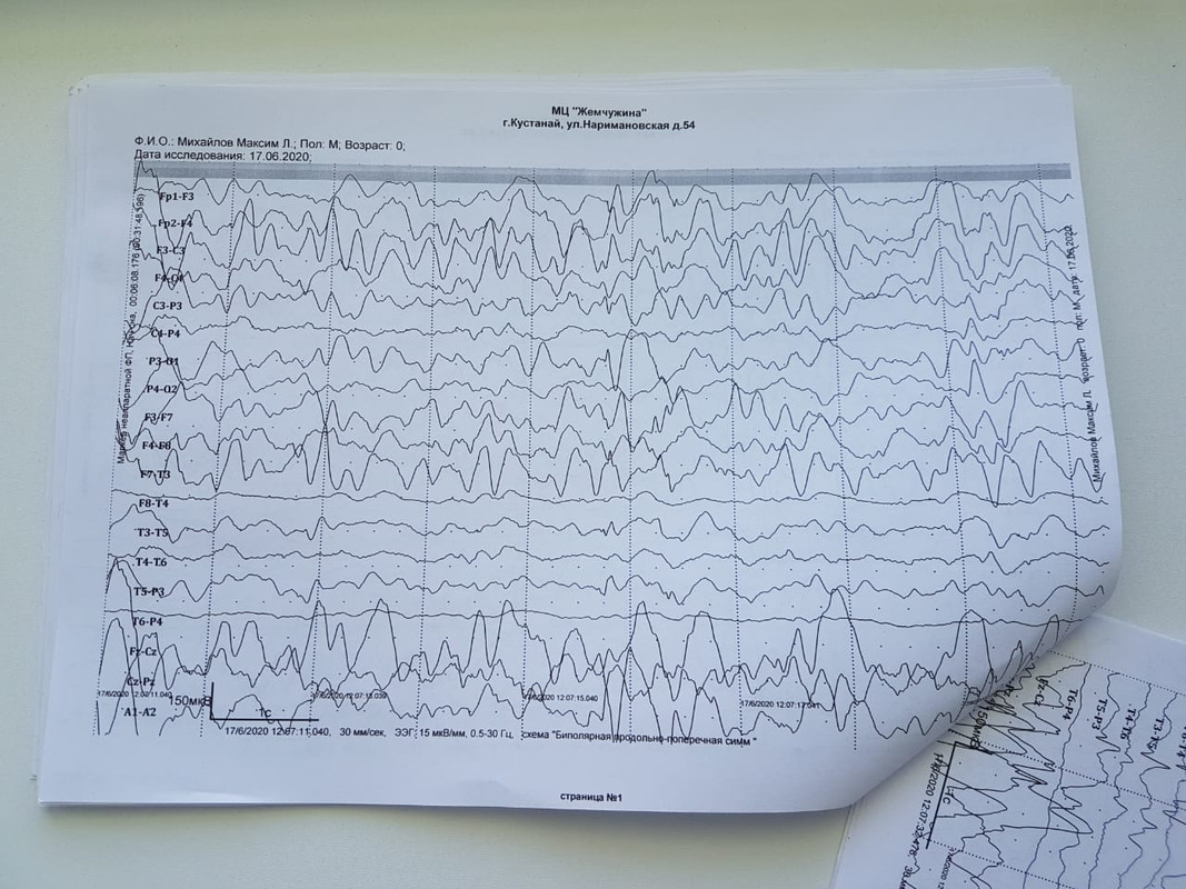 Эпилептиформная активность на ээг у ребенка. Журнал ЭЭГ регистрации.