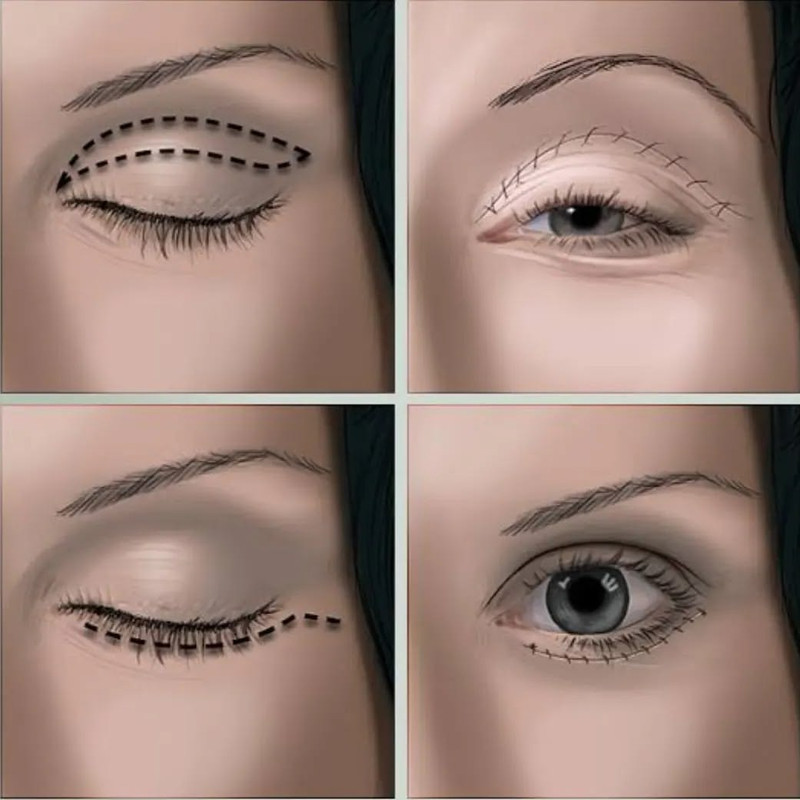 Blepharoplasty Before & After