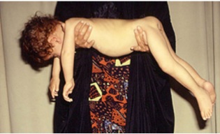 Clinical photograph showing a floppy infant with hypotonia, frog-leg posture, and lack of antigravity movements, characteristic of spinal muscular atrophy