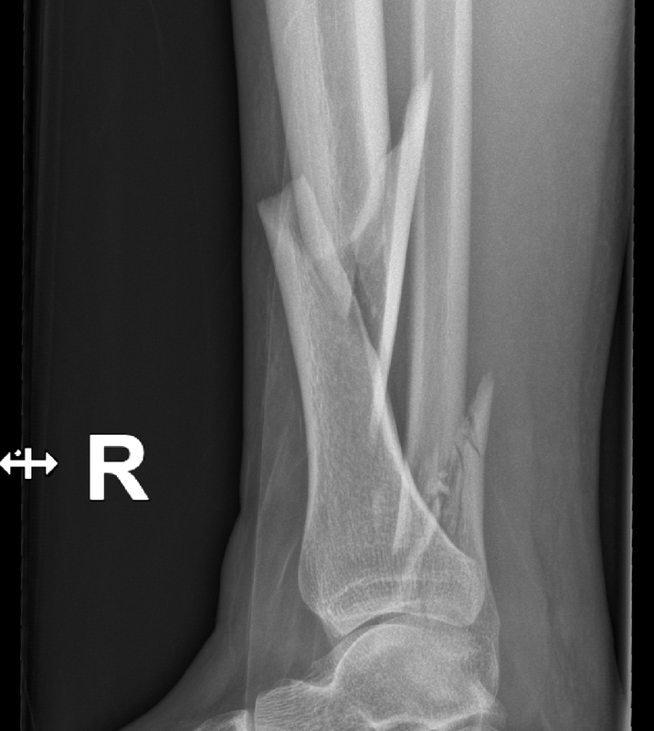 18 12 25 gleženj lat d 1