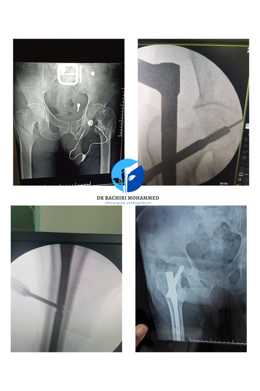 Clou gamma pour fracture par Dr. Bachiri
