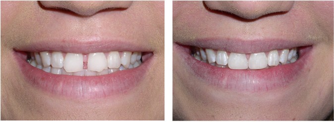 Dental Bonding Treatments