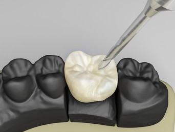 Coroas sobre Implante