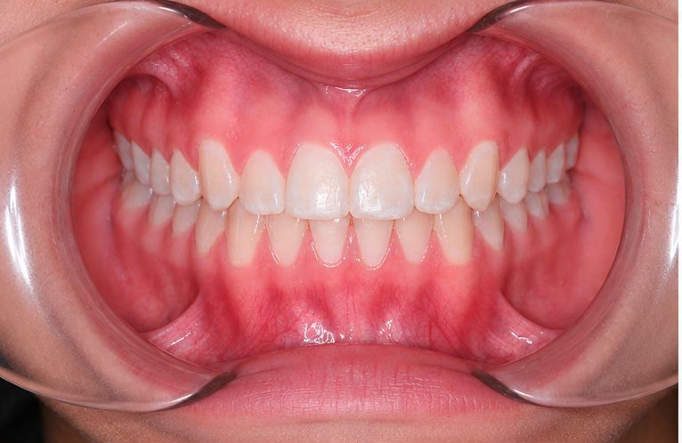 Sonrisa final luego de ortodoncia