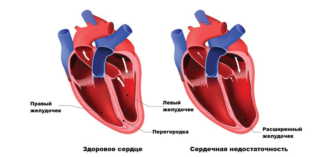 Миокард правого желудочка сердца. Гипертрофия левого желудочка и гипертрофическая кардиомиопатия. Дилатационная кардиомиопатия и гипертрофическая кардиомиопатия. Кардиопатия гипертрофия. Гипертрофия МЖП сердца что это.