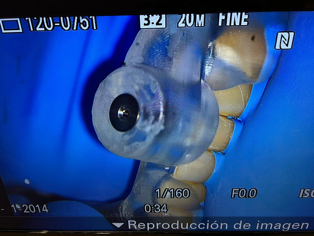 Endodoncia Guiada
