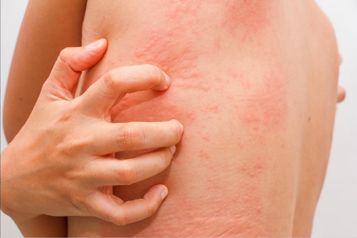 Ronchas y dificultad para respirar son signos de alergia por medicamentos