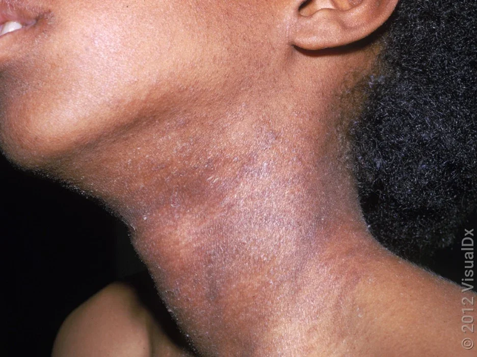 Psoriasis on dark skin