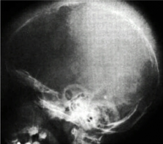 Skull X-ray showing hair-on-end appearance in thalassemia