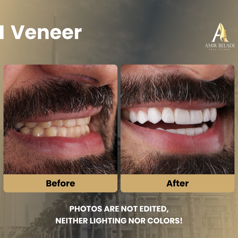 Before/After Smile 4