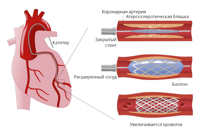 QCA - Les Differents Cas de Figure - Traitement Medical, Angioplastie  Coronaire, Chirurgie Cardiaque