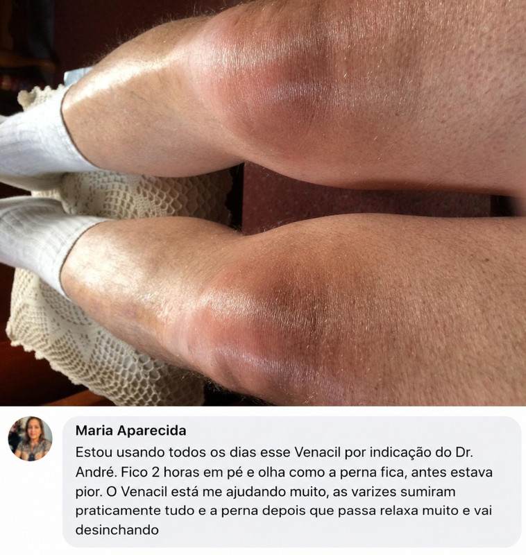 Resultado real de cliente creme para varizes