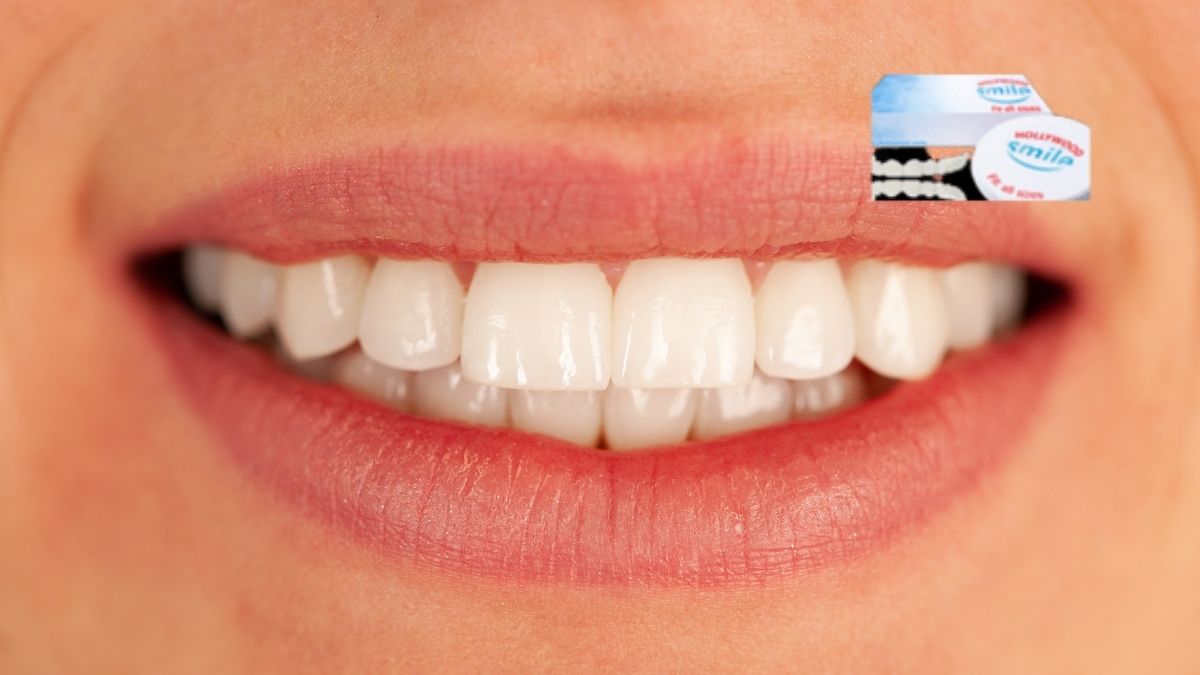 Hollywood Smile veneers