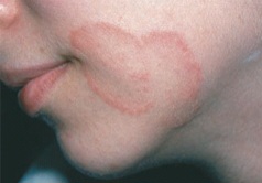 Clinical photograph showing an annular erythematous plaque with central clearing and an active scaly border on the arm, characteristic of tinea corporis (ringworm)