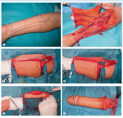 ftm penis arm sausage