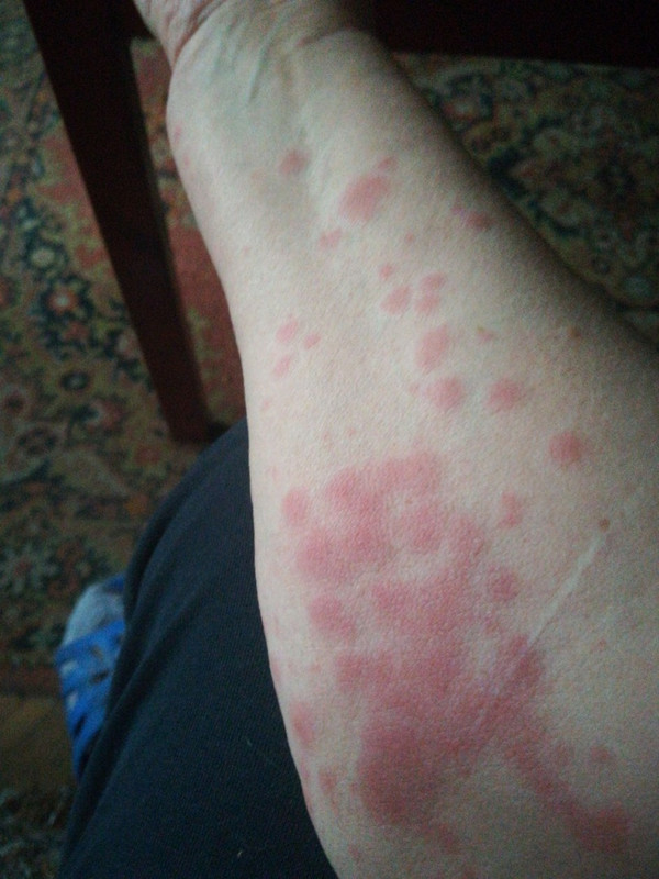 токсидермия